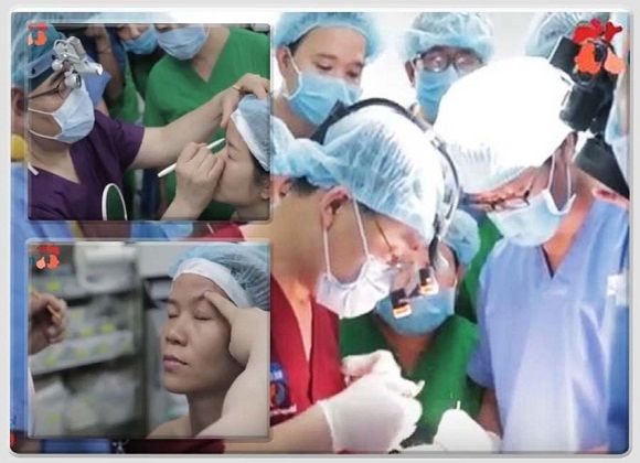 Cơ địa sẹo lồi có cắt mí mắt được không? Chuyên gia tư vấn