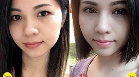 Lấy mỡ mí mắt trên: Xem [VIDEO LIVESTREAM] quy trình và hiệu quả