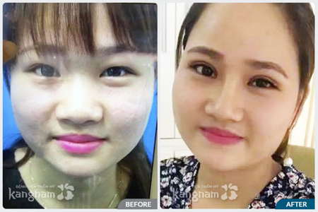 Kết quả trước sau cắt mí mắt trên tại Kangnam