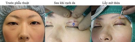 Cận cảnh quy trình cắt mỡ mí mắt trên tại Kangnam
