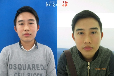 Cách chữa sụp mí mắt tại Kangnam bằng cắt mí mắt Plasma Cách chữa sụp mí mắt tại Kangnam