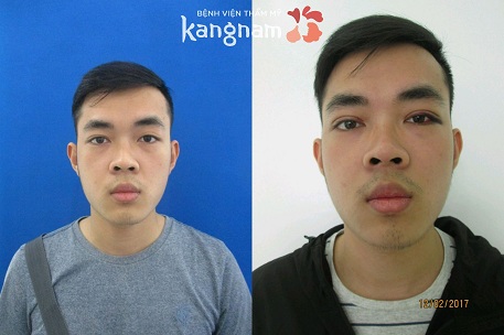 bấm mí mắt hàn quốc dove eyes 3