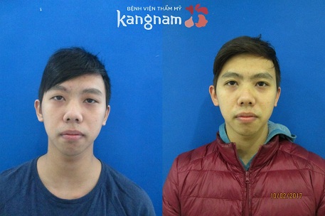 bấm mí mắt hàn quốc dove eyes 2