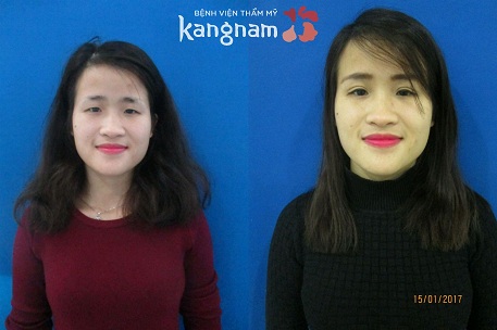 bấm mí mắt hàn quốc dove eyes 4