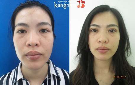 bấm mí mắt hàn quốc dove eyes 5