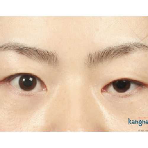 Mắt to mắt nhỏ gọi là gì? 2 Cách khắc phục mắt to mắt bé hiệu quả nhất
