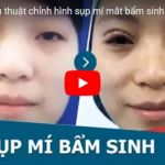 [Video] Cận cảnh kết quả chữa sụp mí mắt bẩm sinh