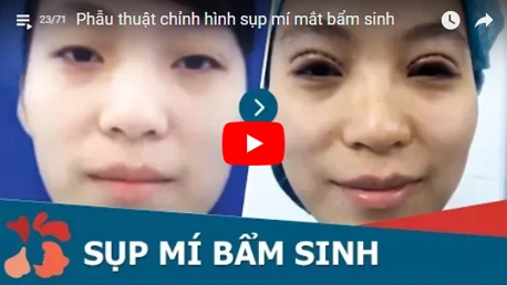 [Video] Cận cảnh kết quả chữa sụp mí mắt bẩm sinh