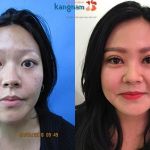 Cắt mí mắt ở đâu đẹp “AN TOÀN – UY TÍN – SỐ 1” tại Hà Nội và HCM?