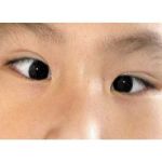 Bệnh mắt lé là gì? Share cách chữa mắt lé nhẹ và nặng hiệu quả nhất