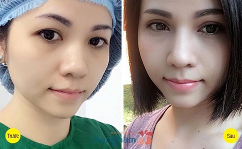 Hình ảnh khách hàng sau cắt mí mắt tại Kangnam