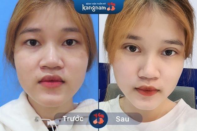 Đường cắt mí tự nhiên, lành lại sau 10 ngày phẫu thuật