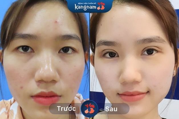 Kinh nghiệm cắt mí Plasma plus