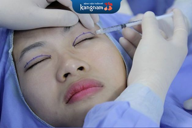 Cắt mí an toàn, nhanh chóng tại Kangnam