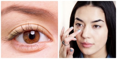 Bọng mỡ mắt là gì? Cách trị bọng mắt to hiệu quả sau 1 lần 5 Bọng mỡ mắt là gì? Cách trị bọng mắt to hiệu quả sau 1 lần 5