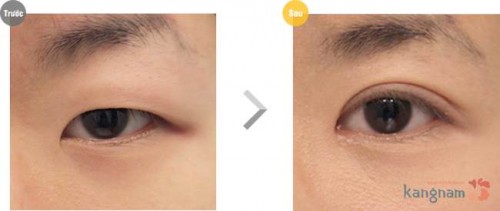 cách làm to mắt 1 mí4753