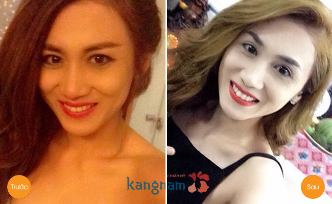 Cắt mí mắt bao lâu thì hết sưng436