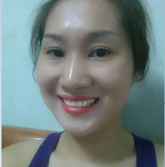 Cắt mí mắt bao lâu thì hết sưng5