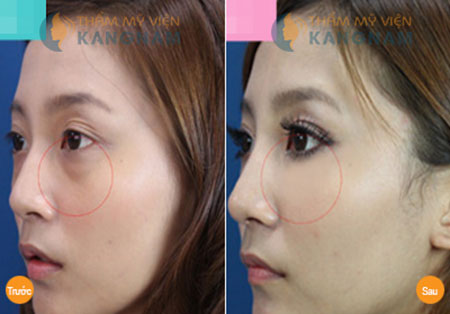 Chia sẻ kinh nghiệm cắt bọng mắt thành công tại Kangnam 6