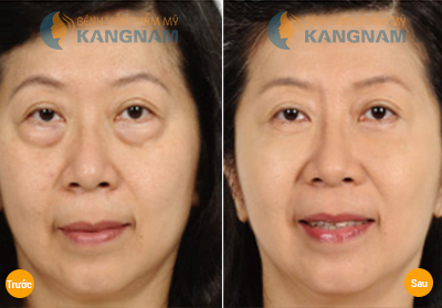 Chia sẻ kinh nghiệm cắt bọng mắt thành công tại Kangnam 4