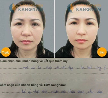 Chia sẻ kinh nghiệm cắt bọng mắt thành công tại Kangnam 2