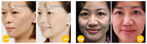 Bọng mỡ mắt là gì? Cách trị bọng mắt to hiệu quả sau 1 lần 1 Bọng mỡ mắt là gì? Cách trị bọng mắt to hiệu quả sau 1 lần