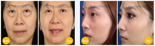 Bọng mỡ mắt là gì? Cách trị bọng mắt to hiệu quả sau 1 lần 1